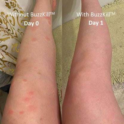 BuzzKill™ Non-Toxic Mosquito Repellant & Bite Healer