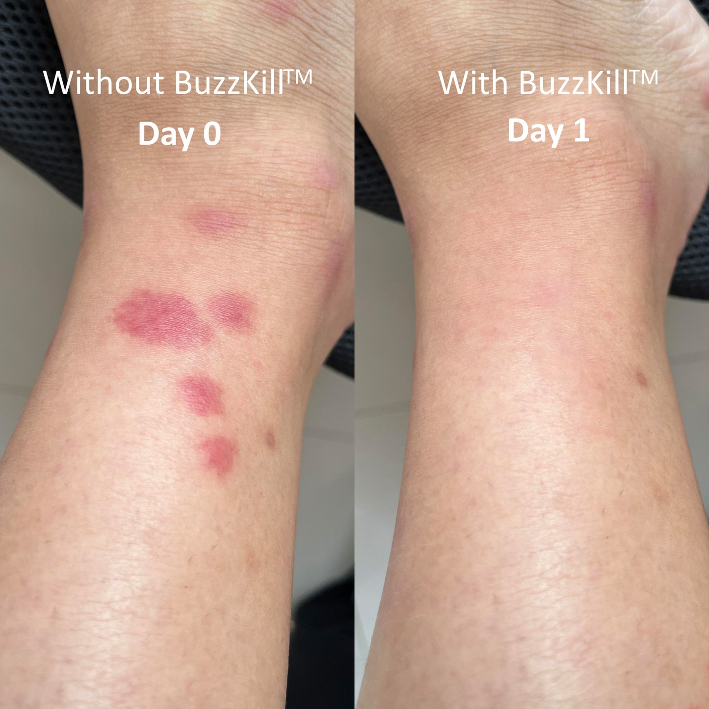 BuzzKill™ Non-Toxic Mosquito Repellant & Bite Healer