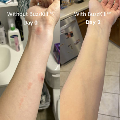 BuzzKill™ Non-Toxic Mosquito Repellant & Bite Healer
